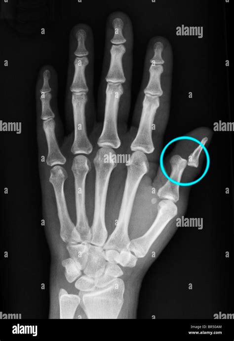 Hand X Ray Of A 36 Year Old Woman Showing A Dislocation Of The Distal