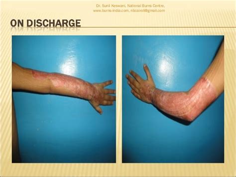 Early excision and skin grafting in burns by Dr. Sunil Keswani, Natio…