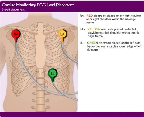 3 Leads ECG Cable and Placement | YQF Medical Cable