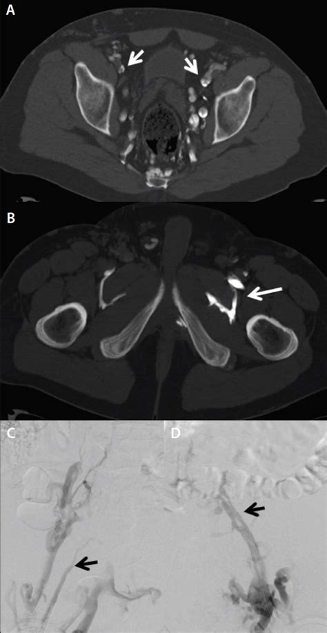 CT Venography Technique And Indications Endovascular Today