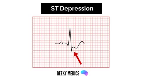 How To Read An Ecg Ecg Interpretation Ekg Geeky Medics