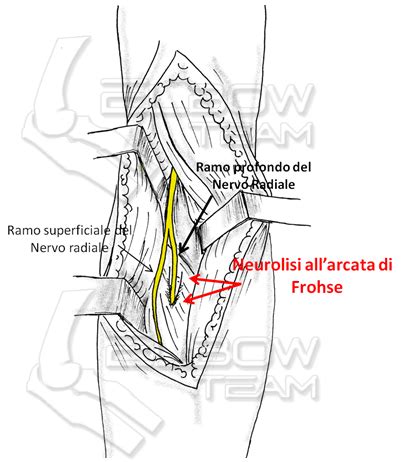 Sindrome Da Compressione Del Nervo Radiale Il Gomito