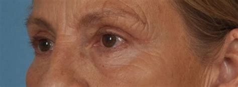 Blepharoplasty Philadelphia Eyelid Surgery In Philadelphia StarkMD