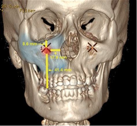 Infraorbital Nerve