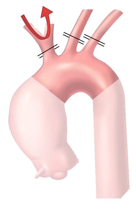 Various Techniques For Unilateral And Bilateral Antegrade Cerebral