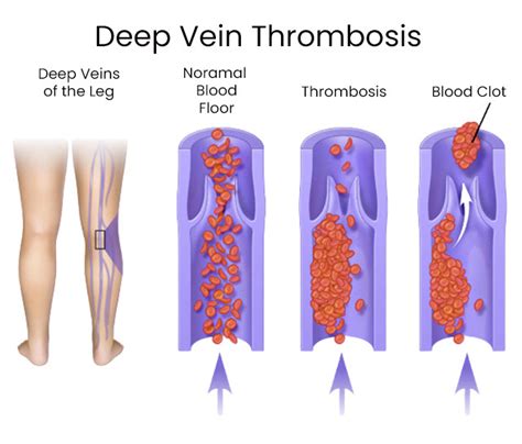 Signs And Symptoms Of Blood Clots Downtown Vein And Vascular