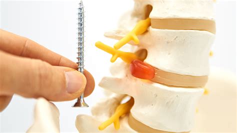 Adjacent Segment Degeneration After Spine Fusion Surgery Regenerative Spine And Joint