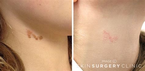 Laser Mole Removal Cost Procedure & Aftercare - Hickey Solution