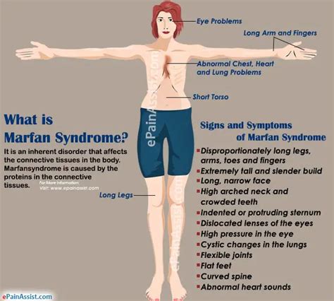 How Is Marfan Syndrome Inherited Causes Symptoms Life Expectancy