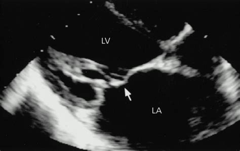 Rheumatic And Nonrheumatic Valvular Heart Disease Circulation