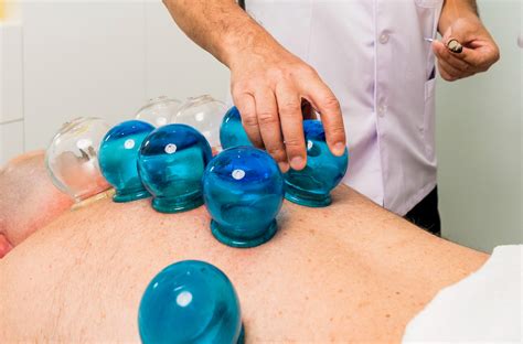 Cupping In Dubai Traditional Chinese Medicine Chinese Medical Center