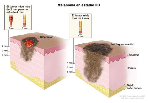 Tratamiento Del Melanoma PDQ NCI