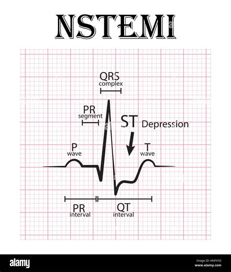 ECG Of Non ST Elevation Myocardial Infarction NSTEMI And Detail Of