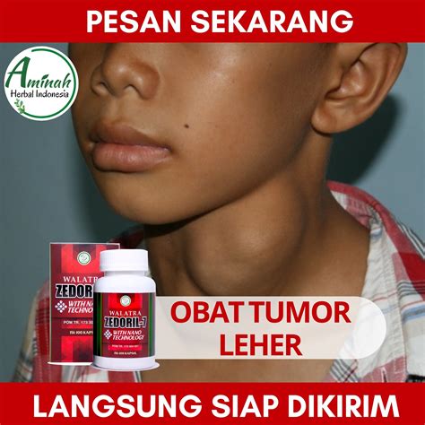 Obat Tradisional Tumor Colli Obat Herbal Tumor Leher Obat Tumor