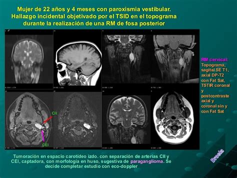 Paraganglioma MRI. Hallazgo casual.