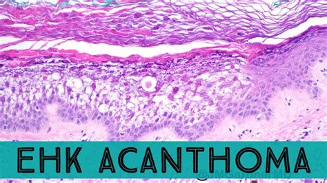 Ehkoma Epidermolytic Hyperkeratotic Acanthoma Solitary Lesion Of