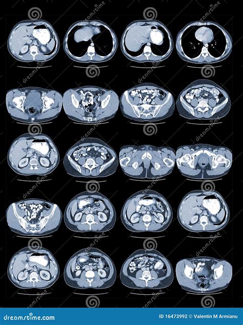 CT Abdomen stock photo. Image of human, nuclear, disease - 16473992