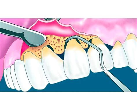 Cu L Es La Importancia De La Cirug A Periodontal Cu Ndo Est