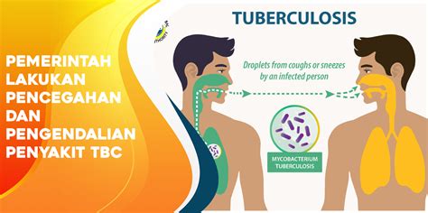 Pemerintah Lakukan Pencegahan Dan Pengendalian Penyakit TBC