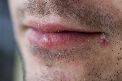 Water Blister On Lips Pictures Photos