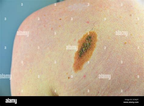 Benign Nevus