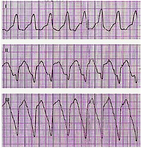 Sinus Ventricular Tachycardia