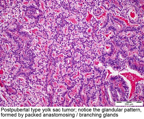 Pathology Outlines Yolk Sac Tumor