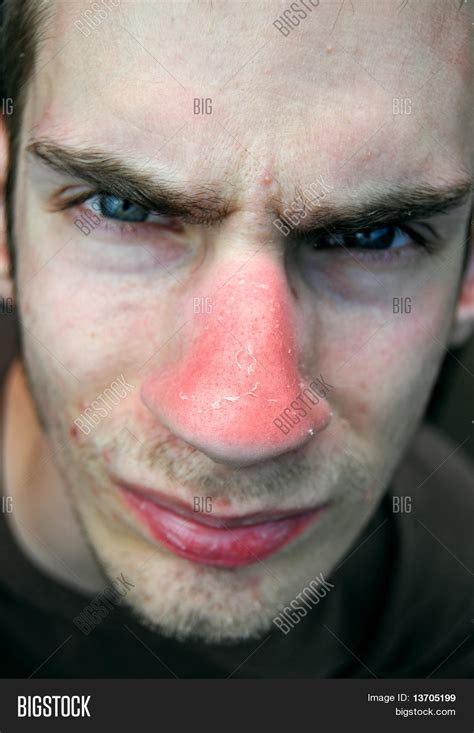 Nose Sunburn Image & Photo (Free Trial) | Bigstock