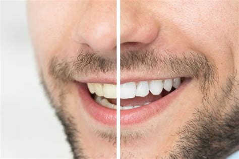 How Much Does Teeth Whitening Cost In Rapid City SD