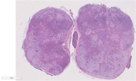 Pleomorphic adenoma – BosnianPathology