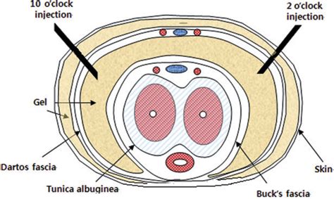 Figure 2 From The Effects Of Penile Girth Enhancement Using Injectable