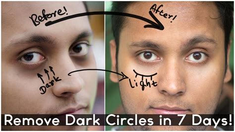 Cure For Dark Circles / Dark circles under the lower eyelids are common in men and women. - Urlex