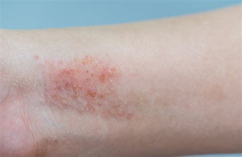 Skin Management Eczema Prone Skin Ceradan