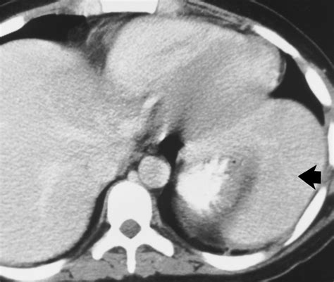 Hypertrophic Accessory Spleen In A Young Girl With Hereditary