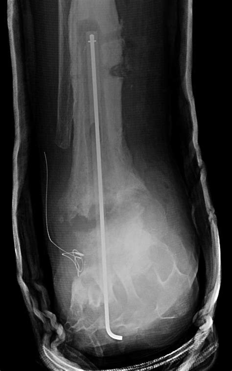 arthrodesis | The Foot and Ankle Online Journal