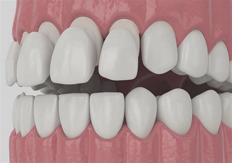 Dental Veneers in Stamford, CT | Press on Veneers Teeth