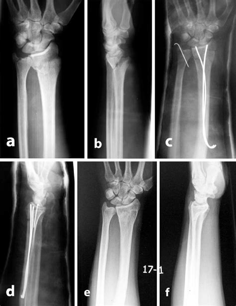 A And B Preoperative Radiographs Of A Year Old Male With Frykman S