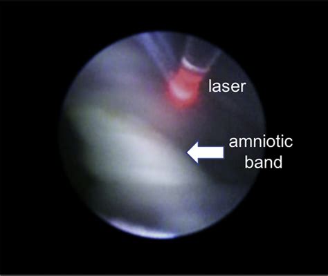 Early Release Of Amniotic Bands Using A 1 0 Mm Fetoscope American