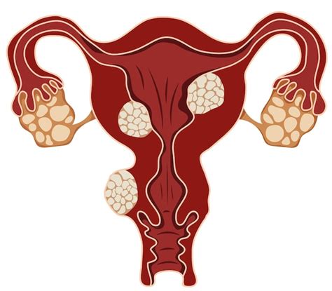 Doença Do útero Reprodutivo Feminino Ou Ilustração De Fibromas Uterinos