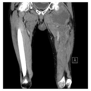 CT Scan A Before The Start Of CTx And B After 2 Cycles Of CTx