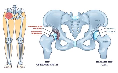 Hip Osteoarthritis Treatment In Mumbai - Dr. Bukalsaria