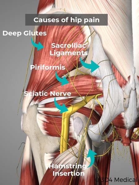 Hip Pain Diagram