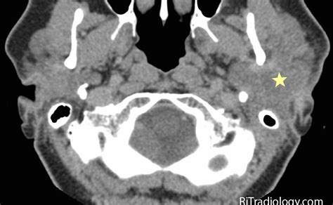 Rit Radiology Parotitis