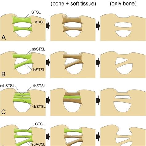 Schematic Arrangements Demonstrating Hypotheses Of Double Suprascapular