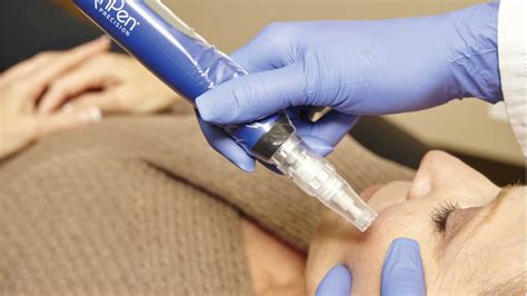 How Skin Pen Micro Needling Can Help Reduce the Appearance of Acne Scars? – Rustoslo