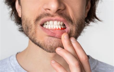 Amoxicillin For Tooth Infection Dosage And How Does It Help