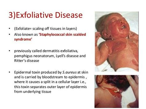 SSSS Lyells Disease Ritters Disease Dermatology Epidermis