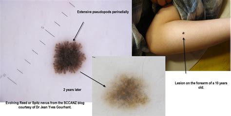 Dermoscopy Made Simple: Reed Nevus