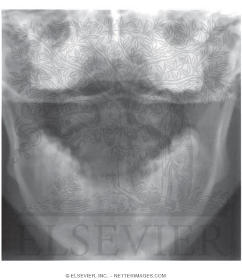 Radiograph of Atlantoaxial Joint