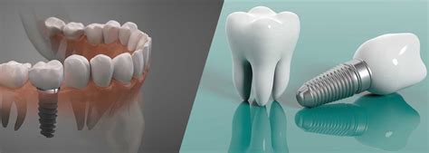 Implantes Dentales En Personas Mayores Los Mejores Beneficios Home